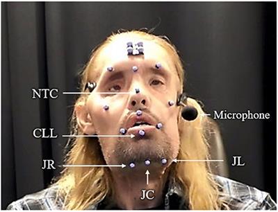 Neuromotor Speech Recovery Across Different Behavioral Speech Modifications in Individuals Following Facial Transplantation